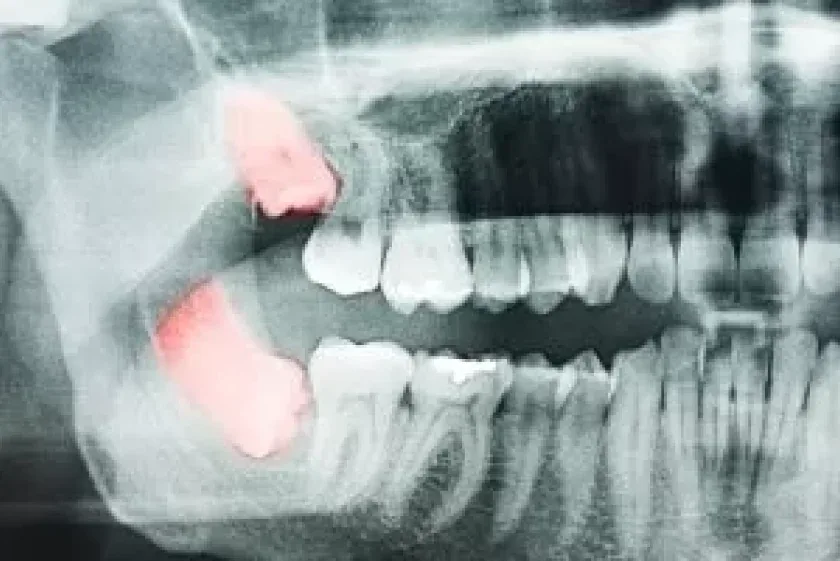 Radiografia panorâmica mostrando dentes inclusos